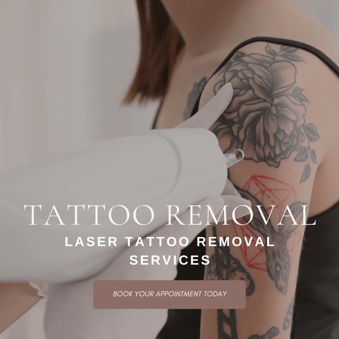 Laser tattoo removal operates th