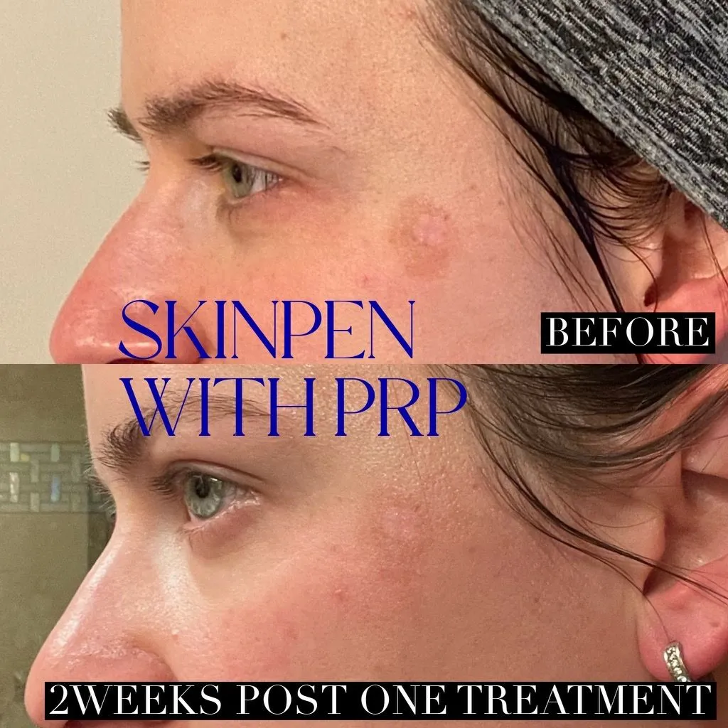 before after skin pen