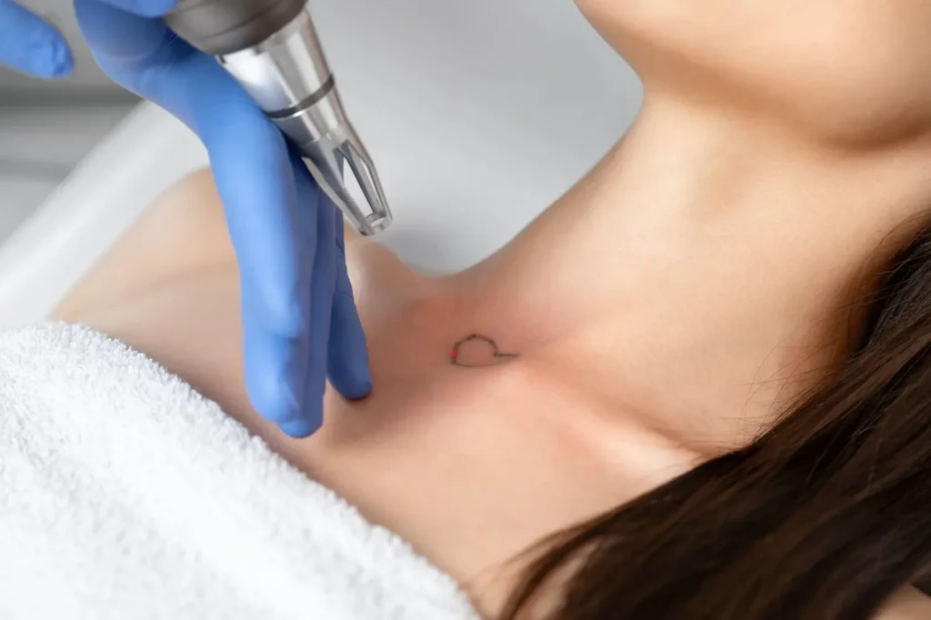 Tattoo Removal in Manitowoc, WI