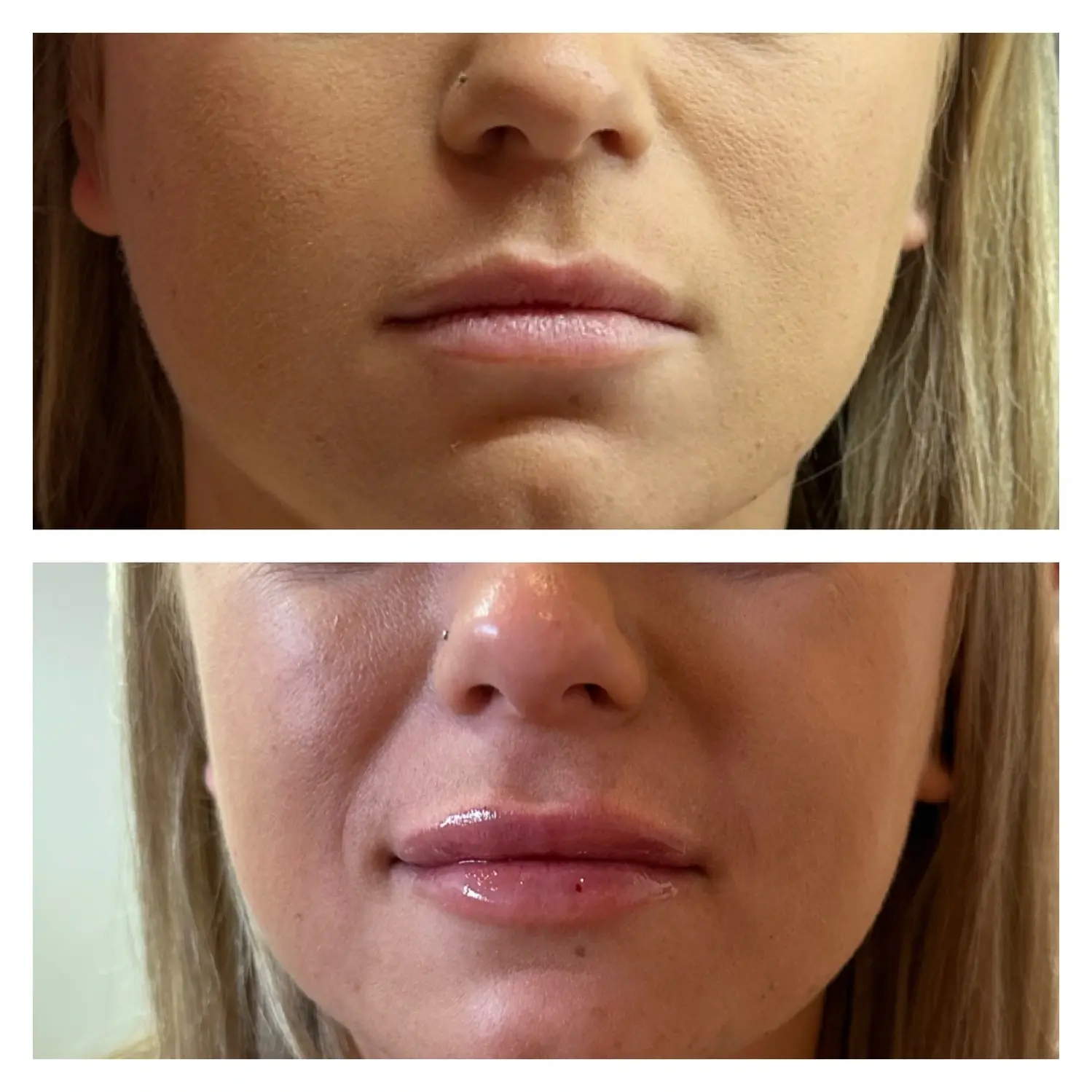 Juvederm Ultra