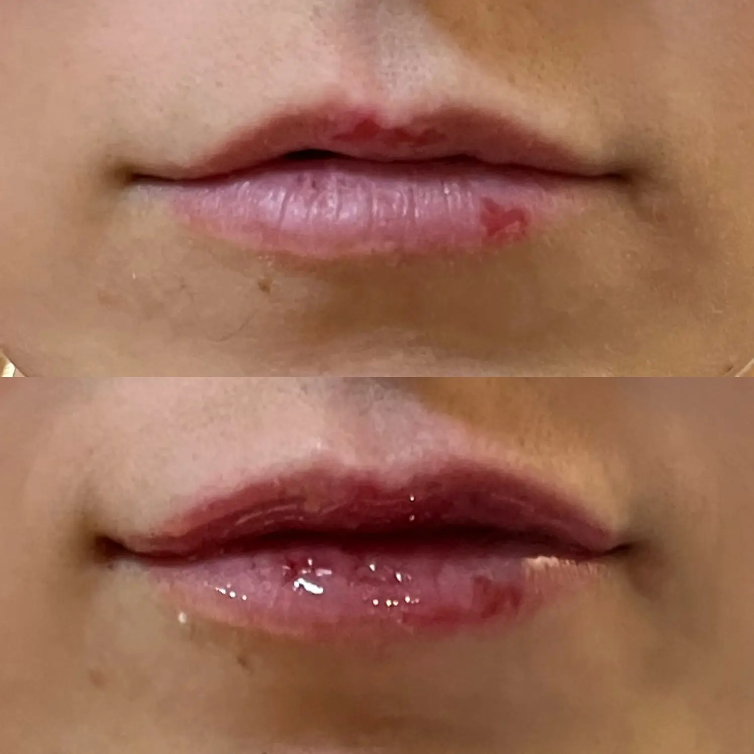 Juvederm Ultra lip filler