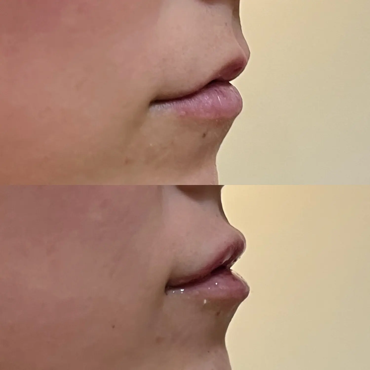 Juvederm Ultra lips